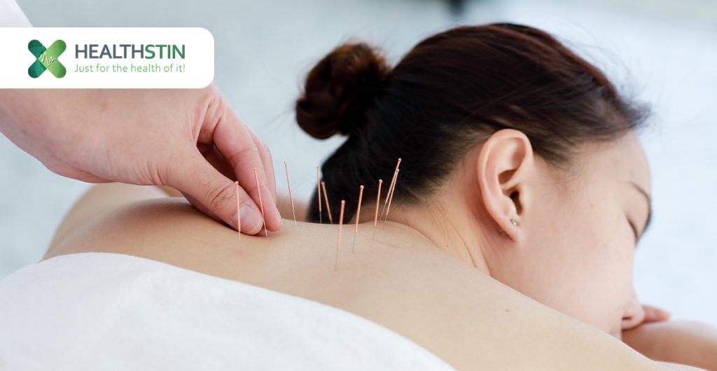 Acupuncture for Headaches and Migraine Relief 4 acupuncture for headaches and migraines